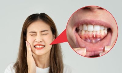 Recesión gingival: un problema que afecta la salud bucal