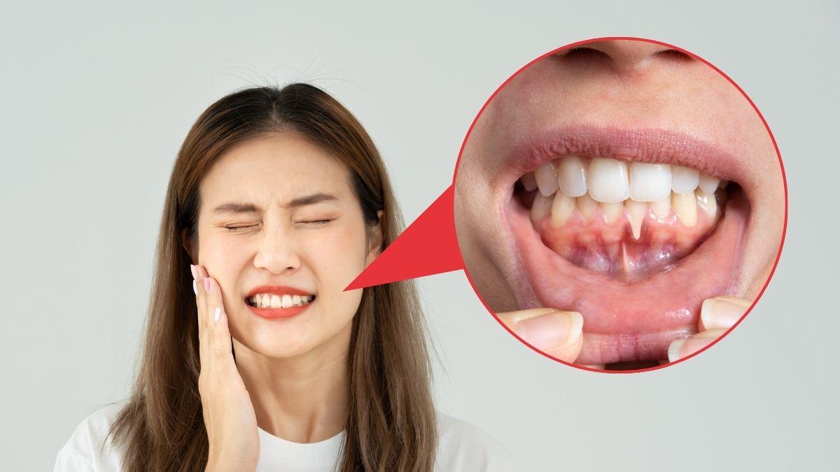 Recesión gingival: un problema que afecta la salud bucal